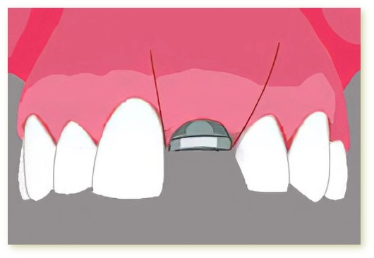 Implants dentaires Crolles