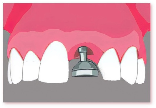 Implants dentaires Crolles