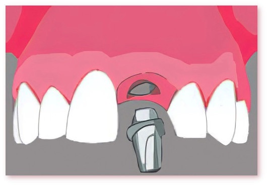 Implants dentaires Crolles