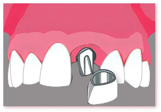 Implants dentaires Crolles