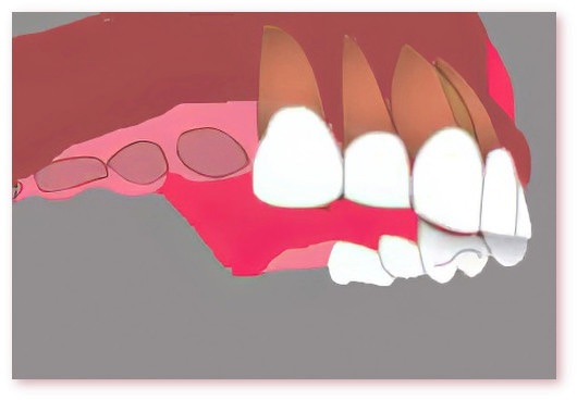 Implants dentaires Crolles