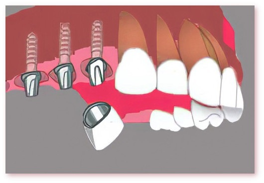 Implants dentaires Crolles