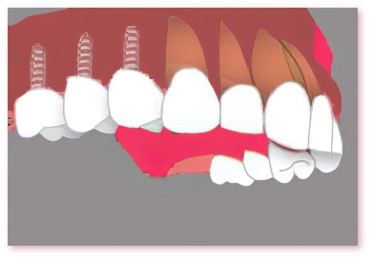 Implants dentaires Crolles