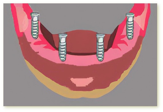 Implants dentaires Crolles