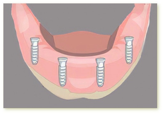 Implants dentaires Crolles