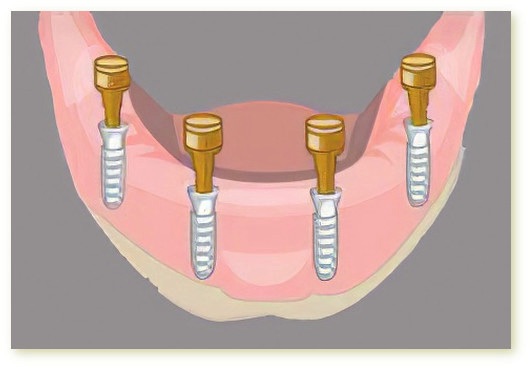 Implants dentaires Crolles