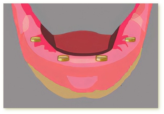 Implants dentaires Crolles