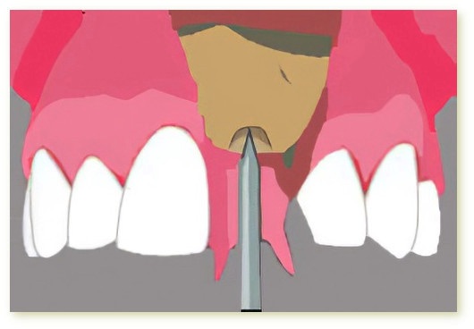 Implants dentaires Crolles