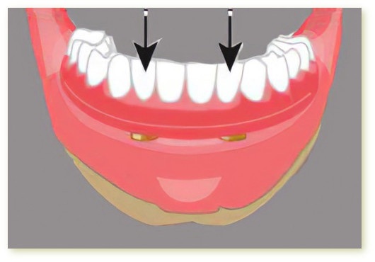 Implants dentaires Crolles