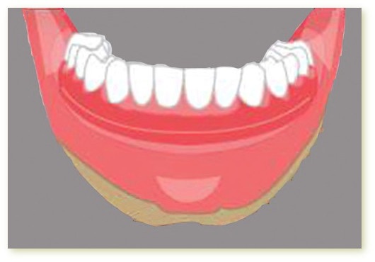 Implants dentaires Crolles