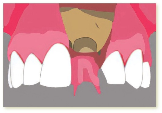 Implants dentaires Crolles