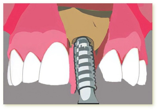 Implants dentaires Crolles