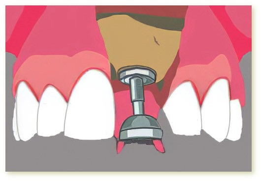 Implants dentaires Crolles